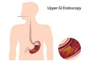 Preparing For Your Upper Endoscopy – What to Know