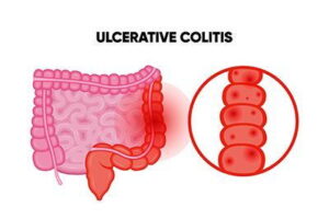 How a Gastroenterologists Treat Ulcerative Colitis & Other Conditions