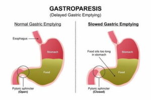 Medical illustration comparing a normal stomach with a stomach affected by gastroparesis