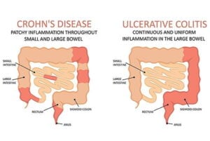 Crohn’s Disease vs. Ulcerative Colitis: What’s the Difference?