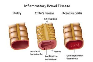 Understanding IBD, Crohn’s Disease, and Ulcerative Colitis