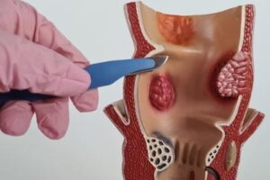 Gloved hand pointing to colon model showing polyps for removal