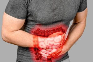 What to Know About Irritable Bowel Syndrome (IBS)